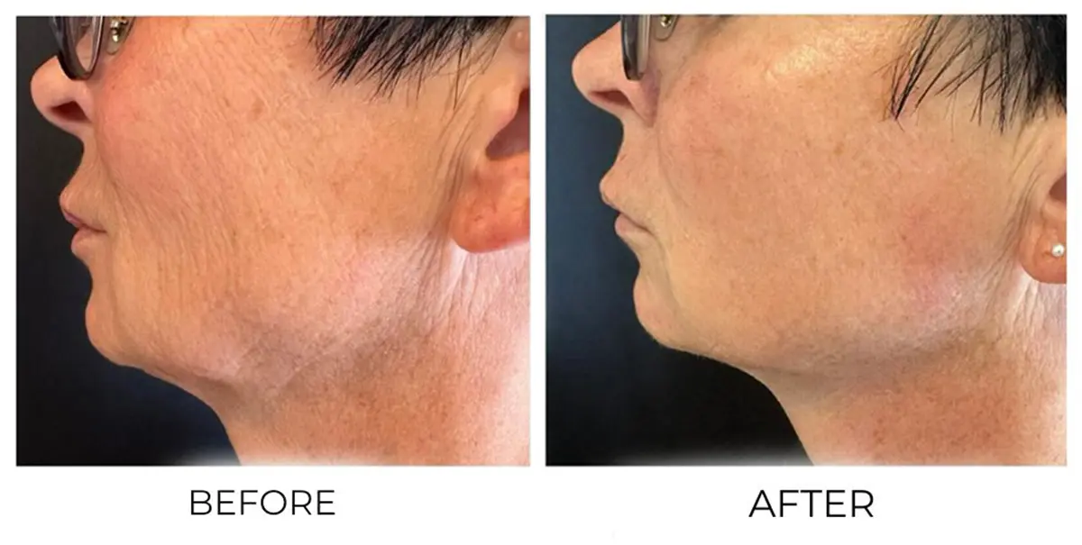 Face & Neck before and after T-Shape 2 Facial results — Before and after T-Shape 2 treatment series