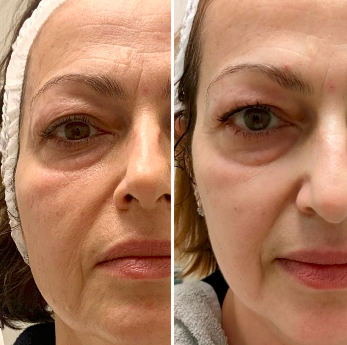 Eye & Cheek Area before and after T-Shape 2 Facial results — Before and after facial treatment
