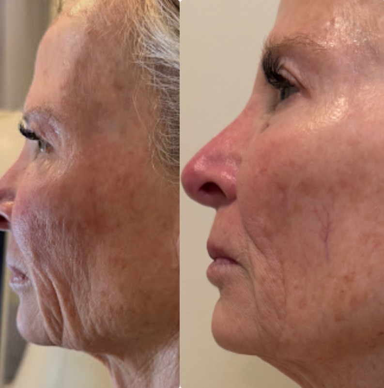 Face & Jawline before and after T-Shape 2 Facial results — Before and after T-Shape 2 facial treatment