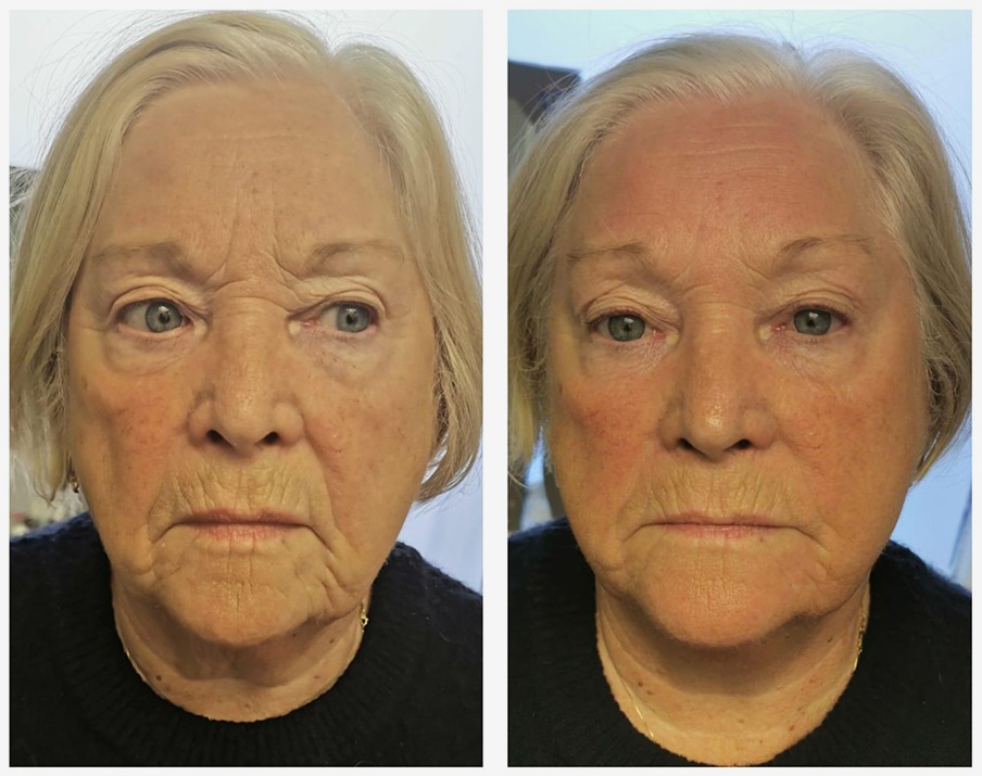 Full Face before and after T-Shape 2 Facial results — Before and after T-Shape 2 facial treatment