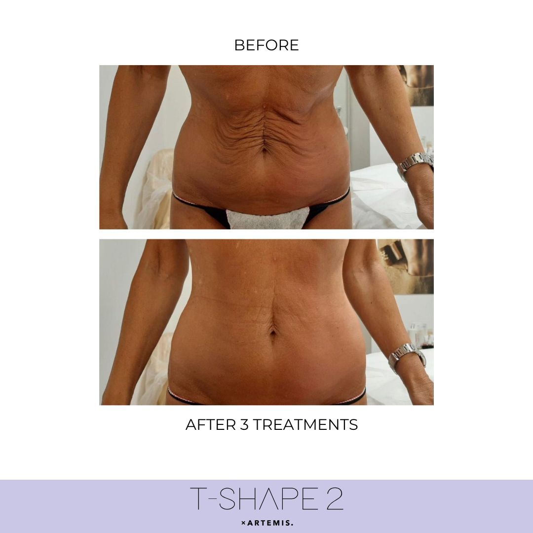 Abdomen before and after T-Shape 2 results — After 3 treatments