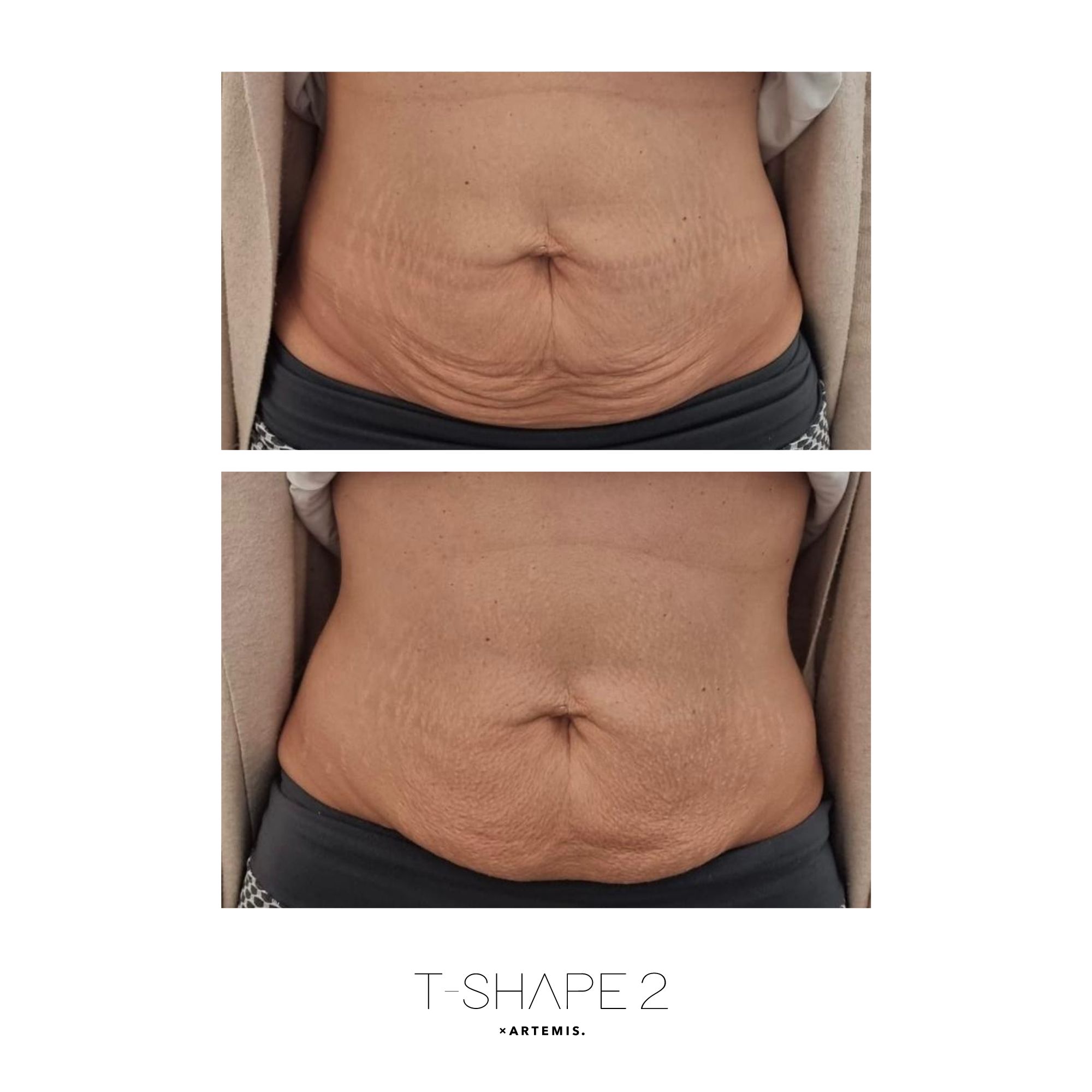 Abs before and after T-Shape 2 results — After treatment series
