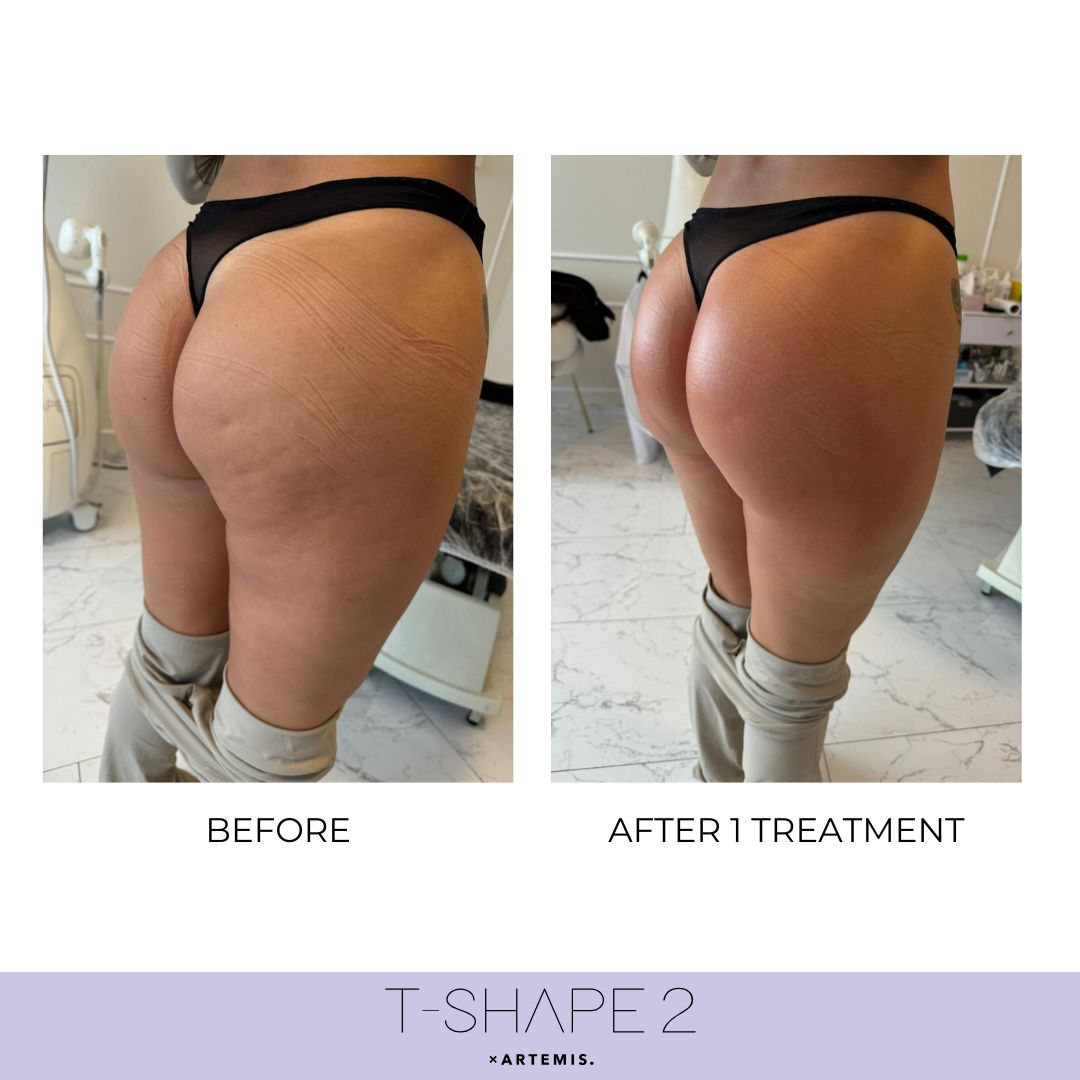 Body before and after T-Shape 2 results — After 1 treatment