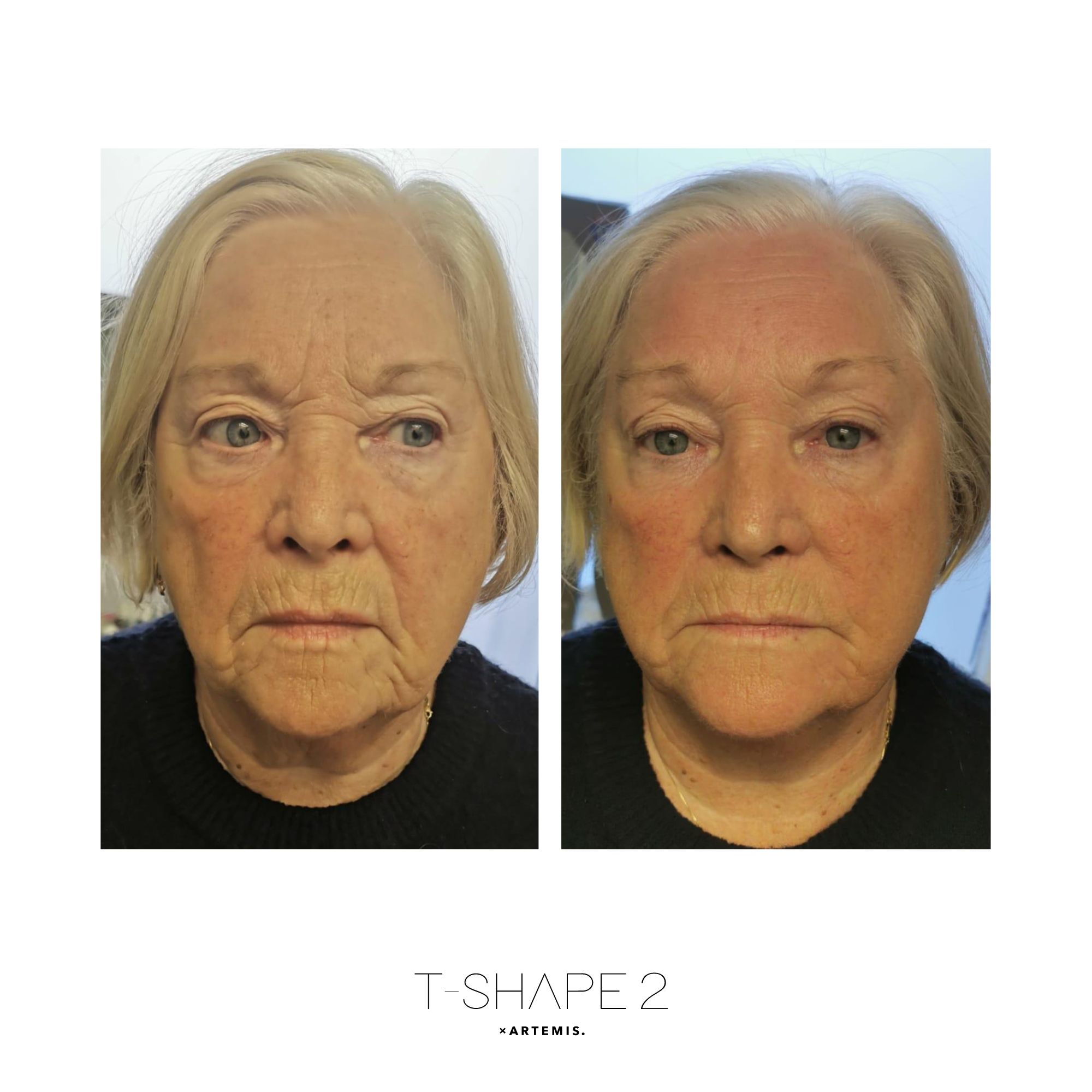 Face before and after T-Shape 2 results — After 1 treatment