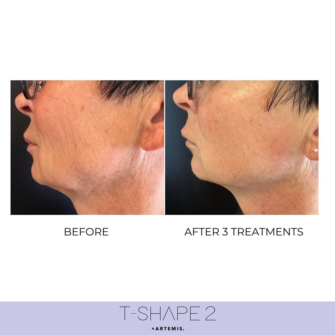 Neck before and after T-Shape 2 results — After 3 treatments